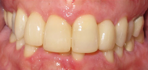 After Bonding on 4 upper front teeth