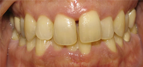 Before Bonding on 4 upper front teeth